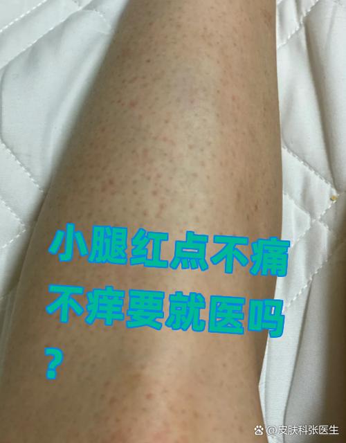 皮肤起红点扩散成圆圈