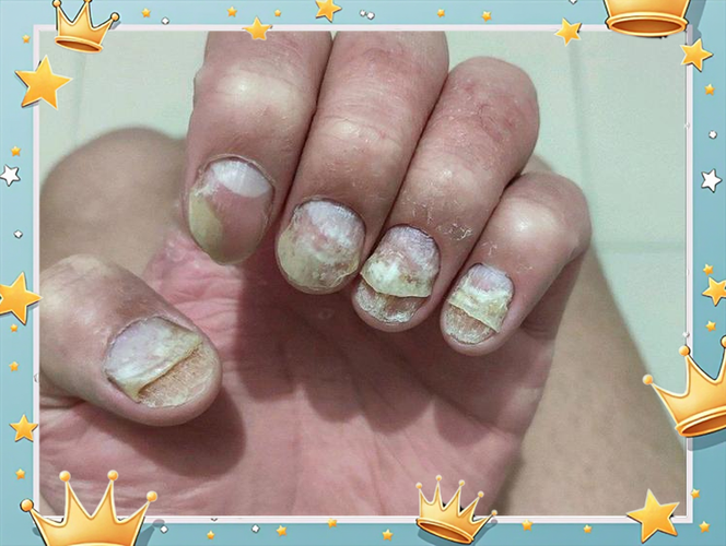 灰指甲可以自己自愈吗