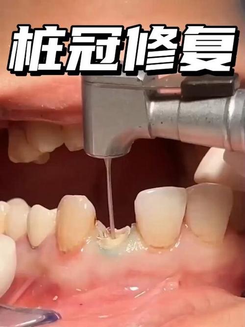 牙齿松动了会自愈吗缩略图