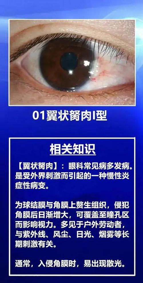 眼睛胬肉会复发吗