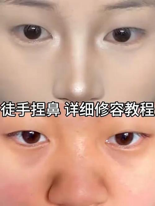 蒜头鼻可以捏小吗