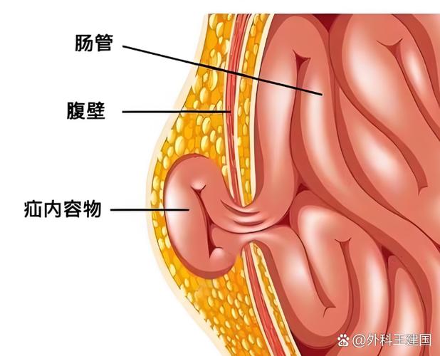 男人疝气图片男性