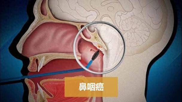 EB病毒的治疗方法