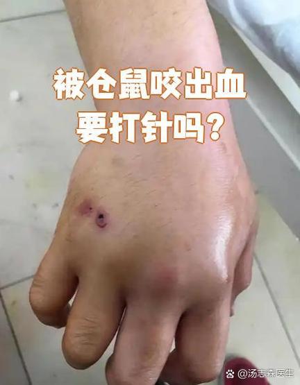 被仓鼠咬了一天后还是疼