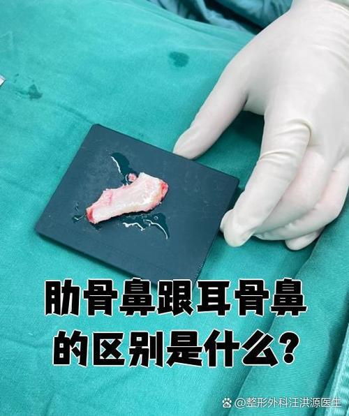 肋骨鼻鼻尖垫筋膜会吸收吗图标