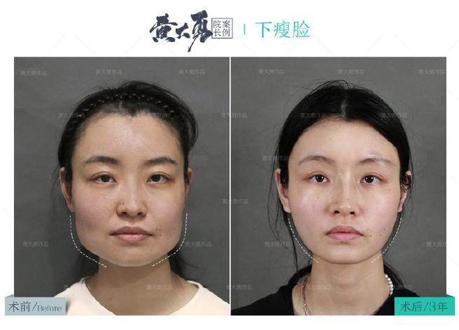 左右脸怎么矫正