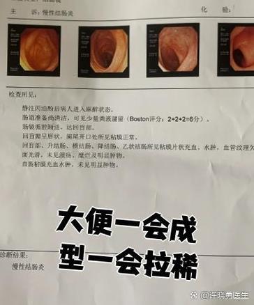 大便长期拉稀是什么病