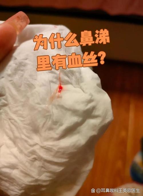 鼻子流鼻血是什么病的前兆
