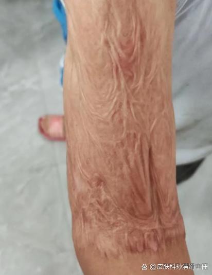 烫伤后增生凸起疤痕怎么去除