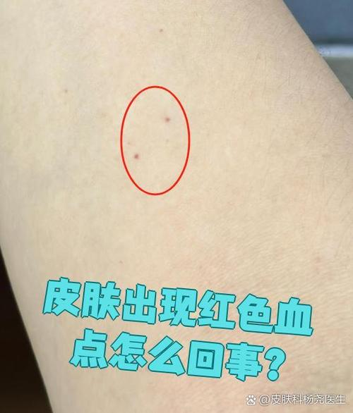 身上起小红血点是怎么回事缩略图
