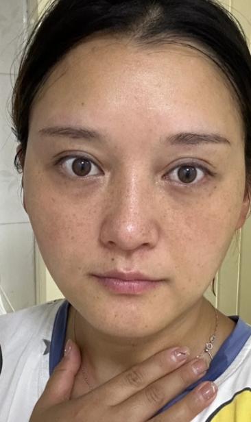 雀斑去除的药膏