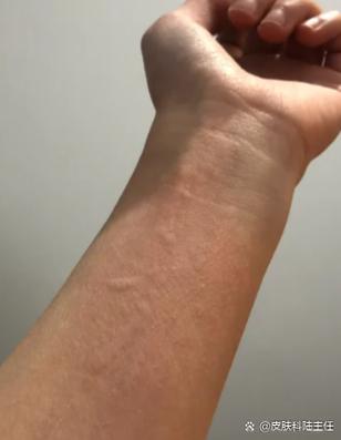 手臂痒痒