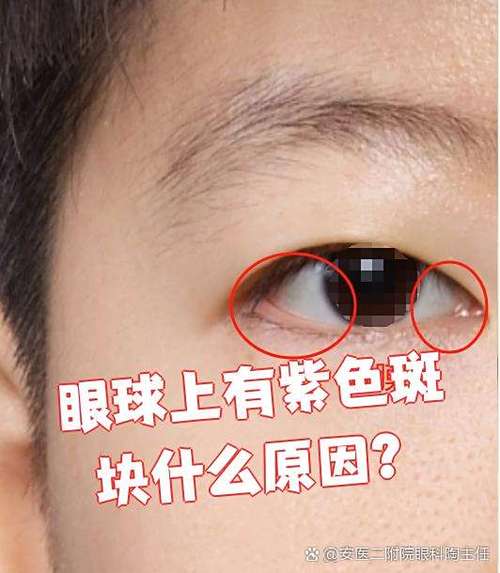 眼睛里有紫斑是怎么回事
