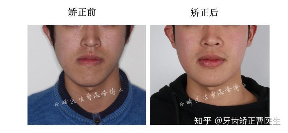 下颌骨错位脸歪图片