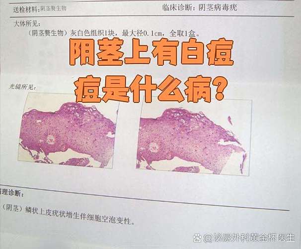 小鸡长疣子怎样处理