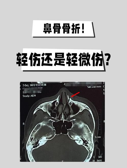 鼻子骨折算几级伤残最新标准