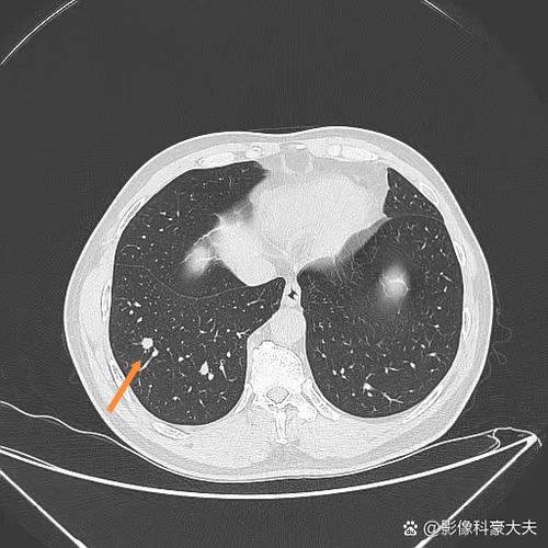 肺片状实变影是不是实性结节