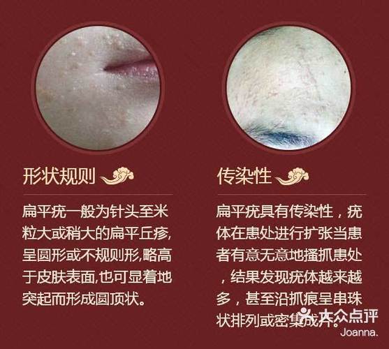 脸上长了红色一直掉皮