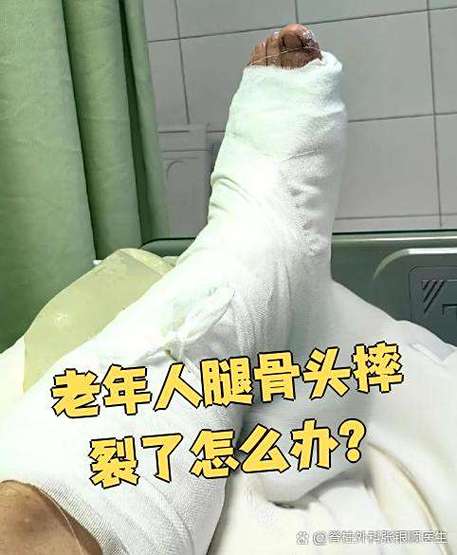 老人摔断了腿对寿命影响吗