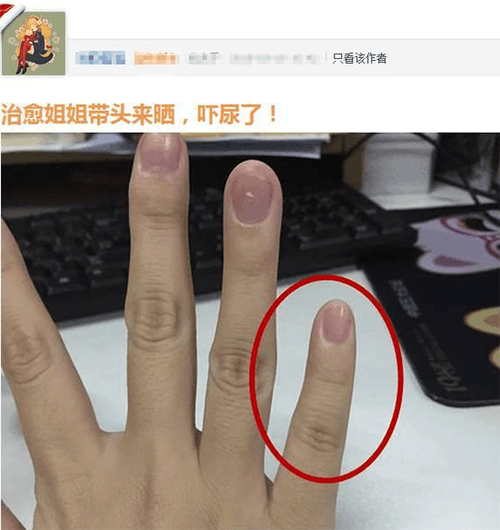 打游戏手指变形