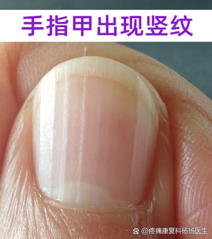 大拇指有竖纹要警惕