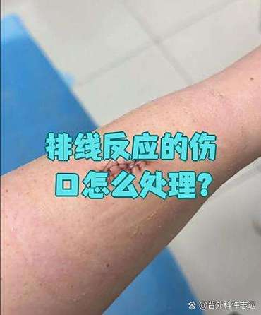排线反应有什么症状