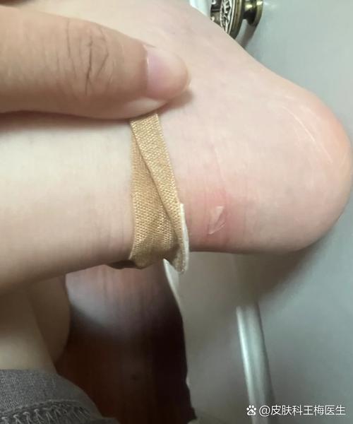 鞋后跟上沿太硬磨脚怎么办