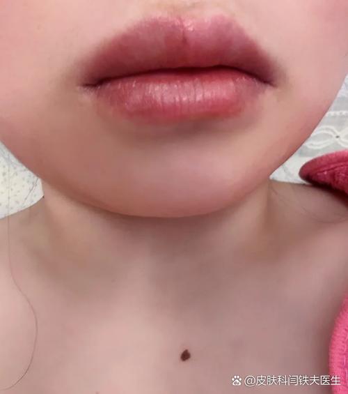 吃芒果嘴肿如何消肿