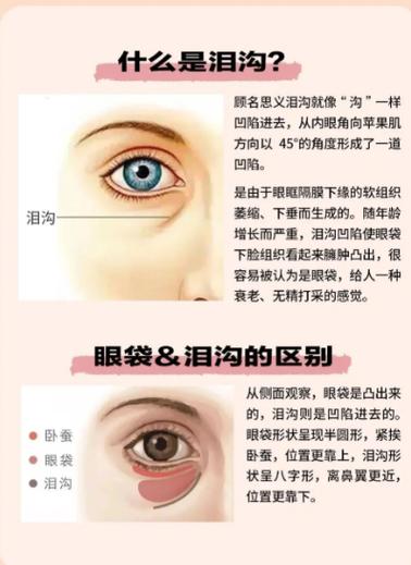 泪沟怎么形成的,怎么去除它