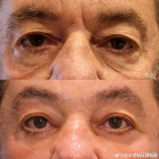 下拉眼的人好吗