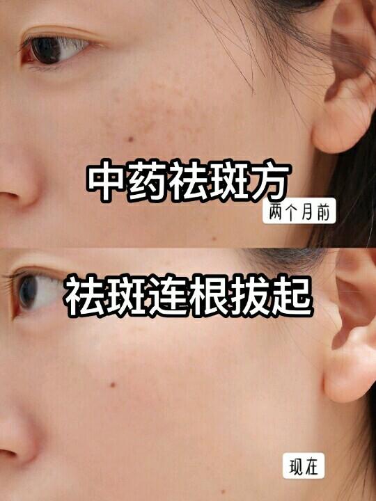 祛斑擦什么药膏最好