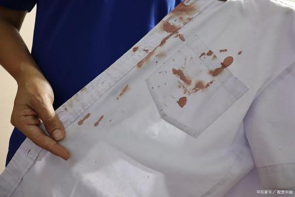 白衣服粘上血怎么去掉