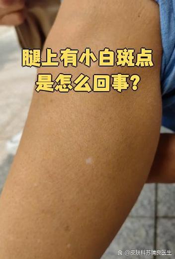 正常白斑游戏截图