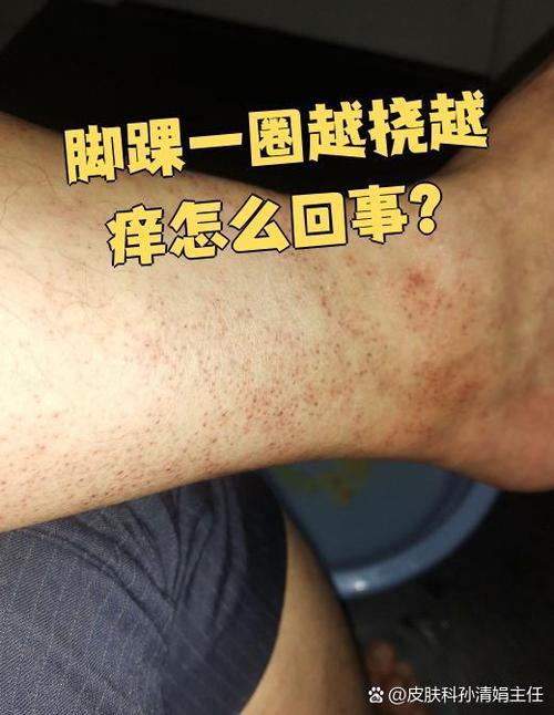 脚太痒了怎么办