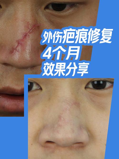刀疤修复版公益系列分享