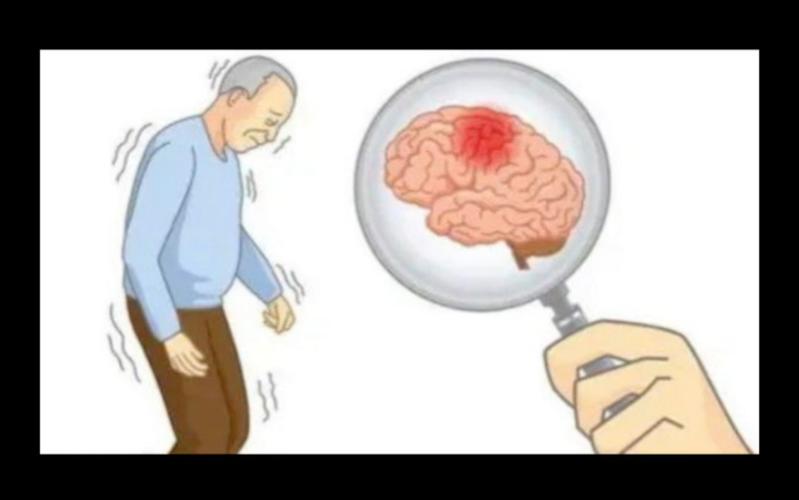 脑梗死是帕金森吗