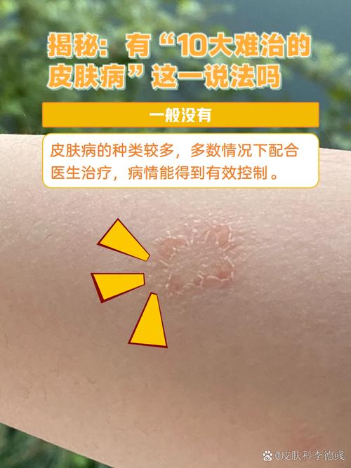 百度扫一扫识别皮肤病