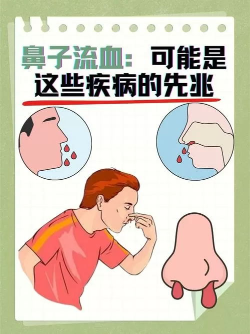 突然流鼻血严重吗