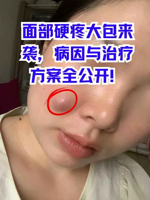 脸上红肿大包还特别疼