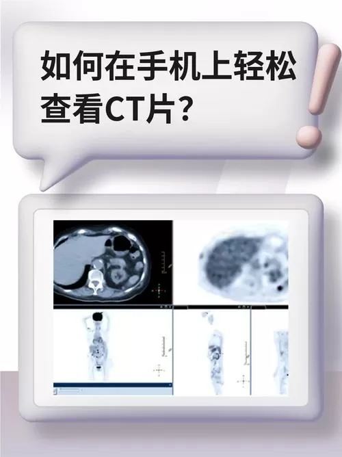 ct在手机上怎么查报告