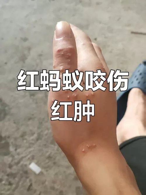 蚂蚁咬人后起红疙瘩图片
