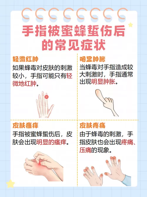 手被蜜蜂蛰了肿了怎么处理
