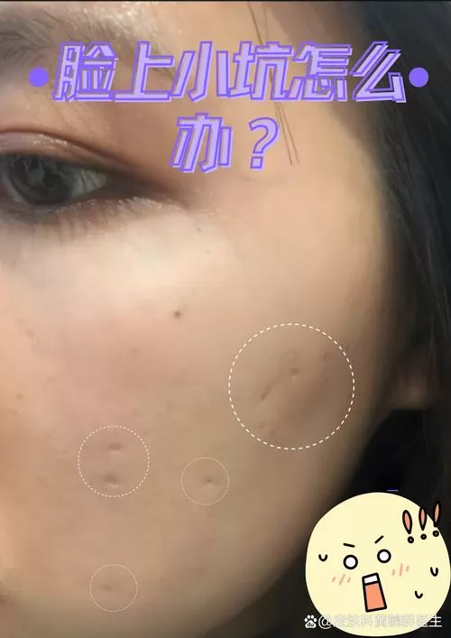 脸上突然出现小坑会自己修复好吗