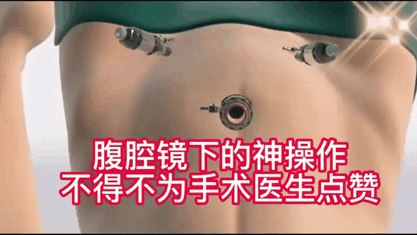 阑尾炎手术3d演示