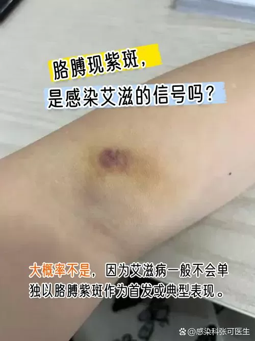 艾滋病紫癜图片