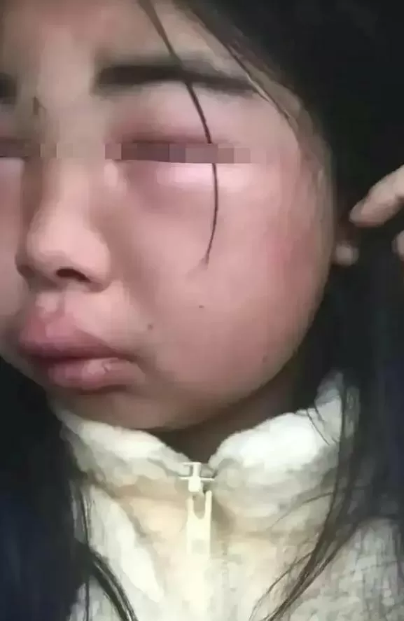 被打耳光第二天脸会肿吗