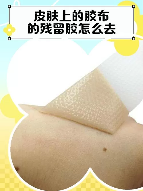 胶布贴了皮肤留下黑印会消吗