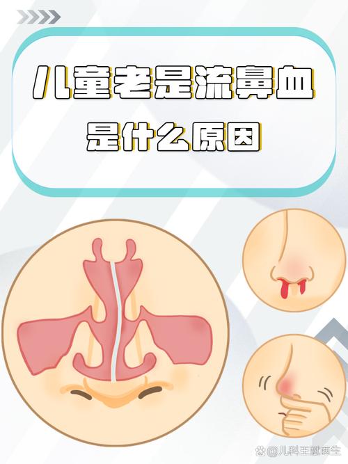孩子老是流鼻血是什么原因截图