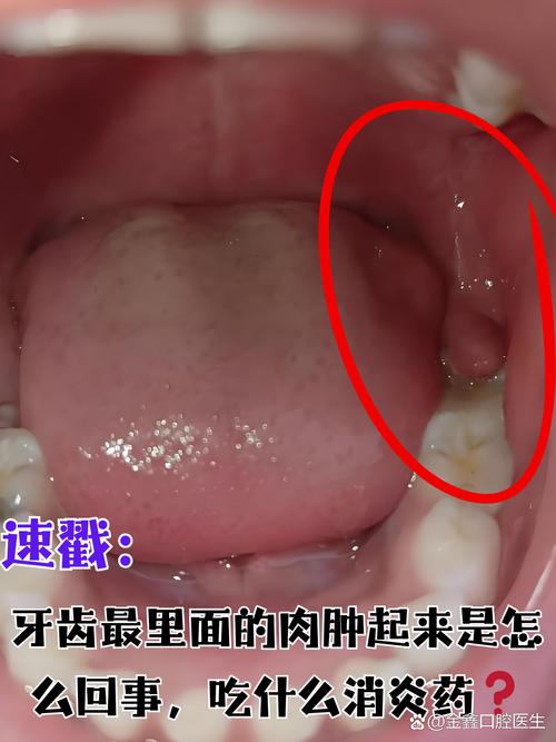 大牙最里面又长了颗牙怎么办红包版