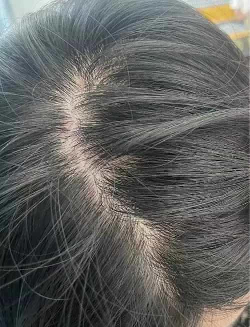 头皮有红疙瘩而且还痒